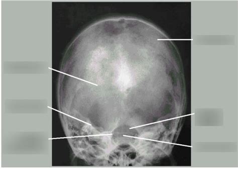 Skull Anatomy 11 Towne AP Axial Diagram Quizlet