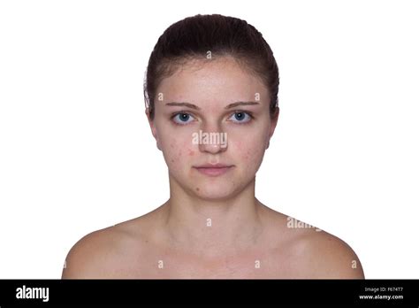 Acne Face Hi Res Stock Photography And Images Alamy