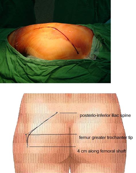 Posterior Superior Iliac Crest