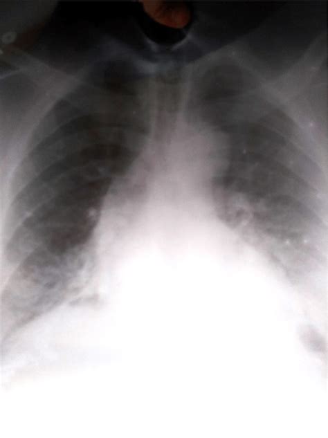 Patients Chest X Ray Showing A Widened Mediastinum Download Scientific Diagram