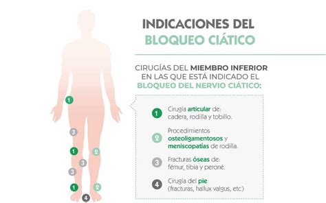 Bloqueo de plexo nervio ciático archivos Campus Vygon