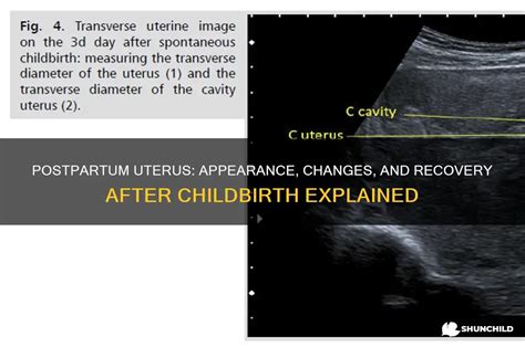 Postpartum Uterus: Appearance, Changes, And Recovery After Childbirth
