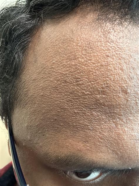 How To Improve My Forehead Skin R Skincareaddicts