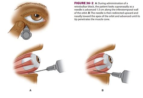 Regional Anesthesia For Ophthalmic Surgery