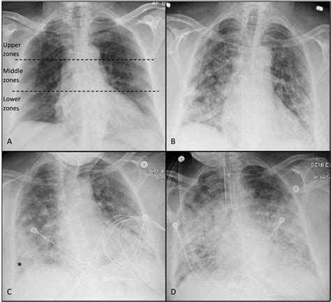 Ap Chest Radiographs Of A 65 Years Old Female Presented With Moderate