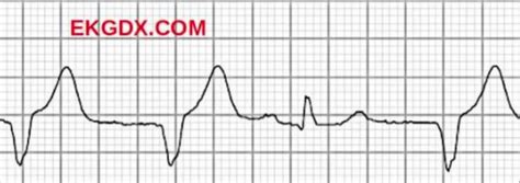 Ekgdx La Nueva Era Del Aprendizaje De Ekg