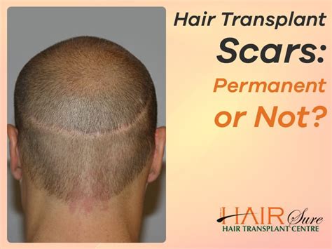 Hair Transplant Before And After Scar