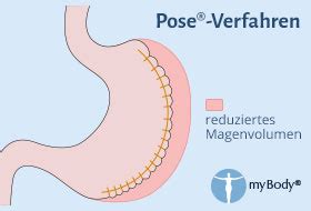 Magenverkleinerung ohne OP bei Übergewicht Kosten Methoden