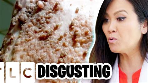 4 Of The Most Disgusting Dr Pimple Popper Moments Ever Part 24 Youtube