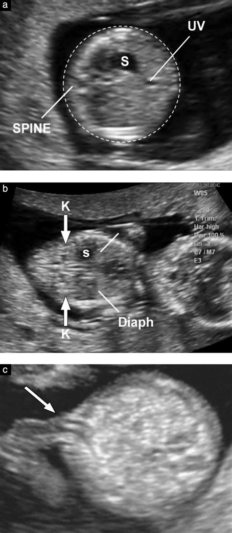 Isuog Practice Guidelines Performance Of Firsttrimester Off