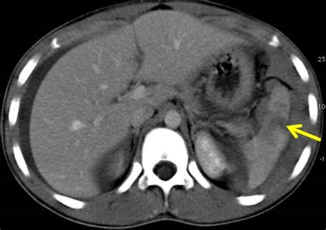 Grade Ii Spleen Injury Radiology Cases