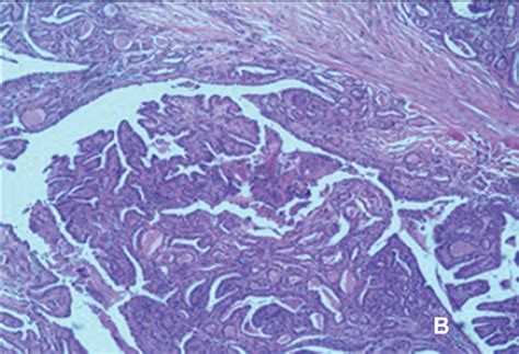 Thyroid Papillary Carcinoma In A 56 Year Old Woman A Conventional Us