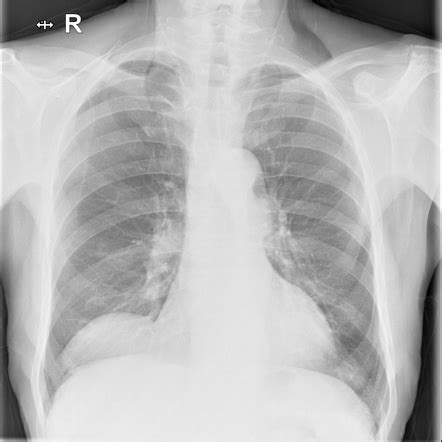 Pericardial cyst | Radiology Case | Radiopaedia.org