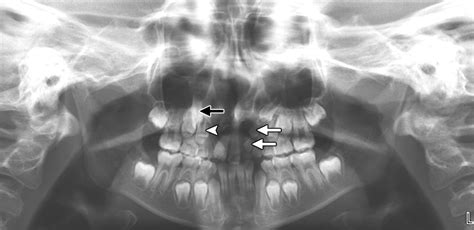 Radiology Of Cleft Lip And Palate Imaging For The Prenatal Period And