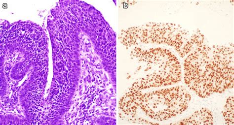 Papillary Squamous Cell Carcinoma Papillary Pattern Of Growth With