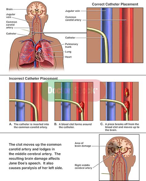 Swan Ganz Catheter Placement