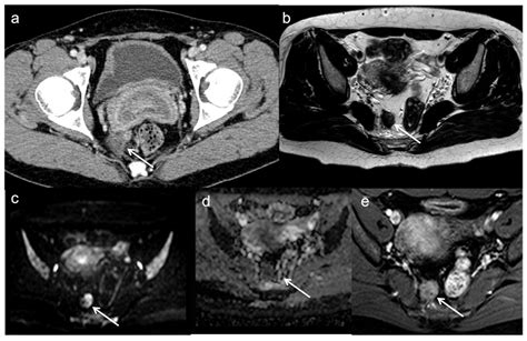 Diagnostics Free Full Text Local Recurrences In Rectal Cancer Mri