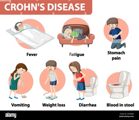 Infograf A M Dica De La Enfermedad De Crohn Imagen Vector De Stock Alamy