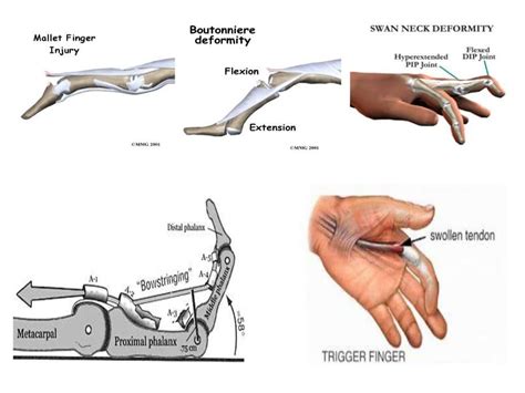 Flexor and Extensor Tendon Laceration vs. Occupational Therapy