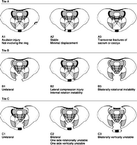 Pelvic Fracture Classification Radiology