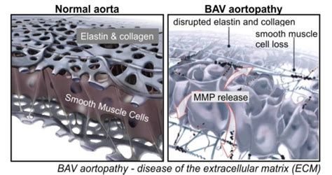 Figure 1 From Evolution Of Precision Medicine And Surgical Strategies For Bicuspid Aortic Valve