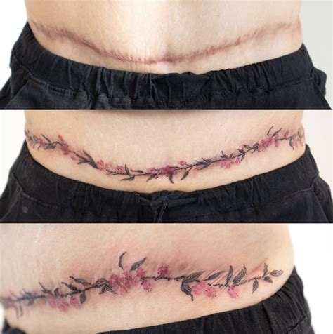 Tummy Tuck Scar Tattoo