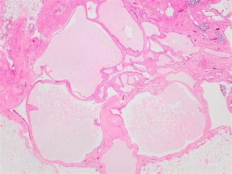 Multicystic Mesothelioma Of Peritoneum This Low Power View