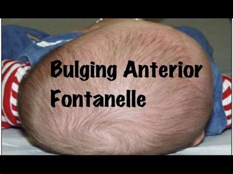 Quick Pediatrics: Causes for Bulging of Anterior Fontanelle - YouTube