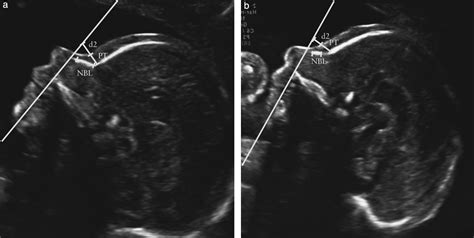 Trisomy 18 Ultrasound Markers