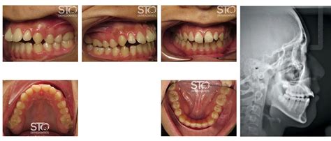 Non Surgical Orthodontics In Scarborough Sto Orthodontists