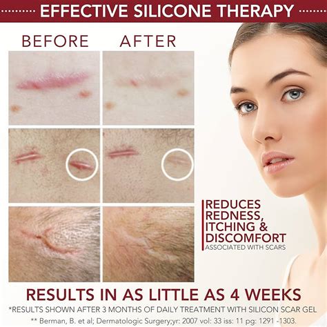 Strataderm Professional Scar Therapy Gel Old And New Scars Off