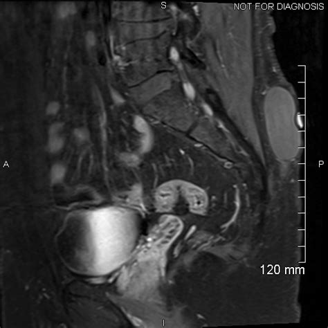 Epidermoid Cyst Image