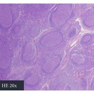 Histopathological And Histoimmunochemical Features Of Lymph Node