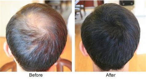 Before and After - Best Hair Loss Concealers | Hold the Hairline