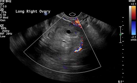 Ovarian Torsion Uams Department Of Radiology