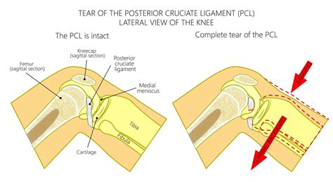 PCL Tear | Frequently Asked Questions