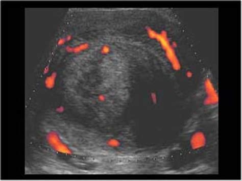 Gynaecology 3 1 Uterus Case 3 1 1 Uterine Fibroids Ultrasound Cases