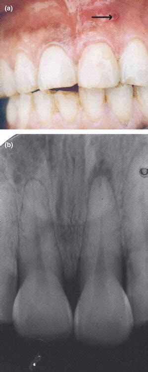 Discolored Maxillary Left Central Incisor Secondary To Trauma Showing A Download Scientific