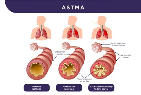 Astma Wilbrink Wassink Fysiotherapie