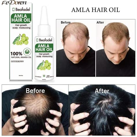 Amla Hair Oil Before And After