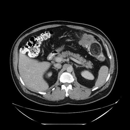 Colocolic Intussusception Due To Lipoma Radiology Case Radiopaedia Org