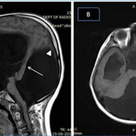 Dandy Walker malformation. A. Sagittal T1W MR image of brain shows ...