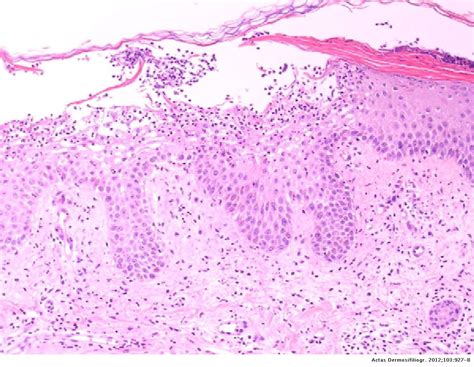 Acute Generalized Exanthematous Pustulosis Histology