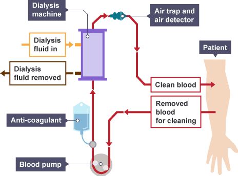 Medsurg Dialysis Flashcards Quizlet