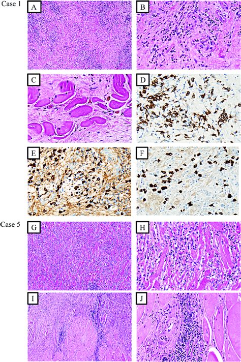 Photomicrographs Of Case 1 A F And Case 5 G J With Representative