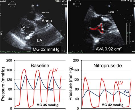 Moderate Mitral Valve Regurgitation Life Expectancy