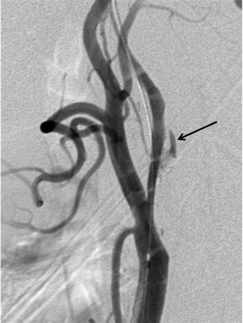 Lateral View Of Post Angioplasty Cca Angiogram Shows Development Of