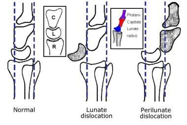 Lunate Dislocation