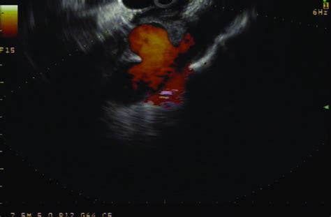 Endoscopic ultrasound image of a celiac artery aneurysm (white arrow ...