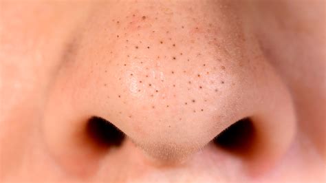 Here S What You Need To Know Before Removing Blackheads